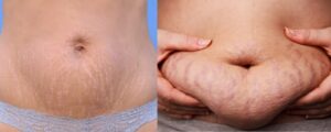 stretch mark merah dan putih