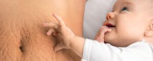 berapa lama stretch mark bisa hilang