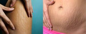 Cara Menghilangkan Stretch Mark Membandel Setelah Melahirkan